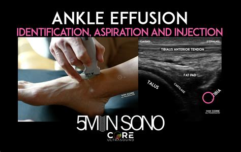 MRI Of Ankle Sprain: The Association Between Joint Effusion, 54% OFF
