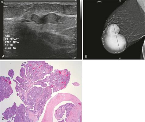 Duct Papilloma Def at Franklin Norwood blog