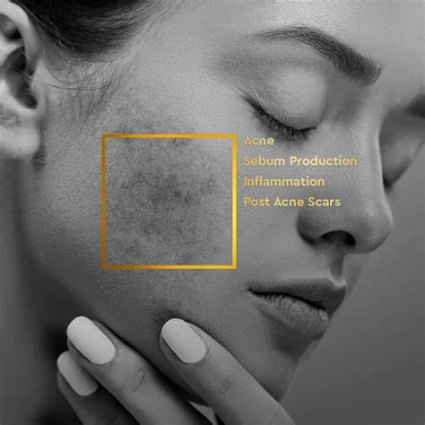 Buy Best Acne Purifying Regime - Acne Reduction & controls excess oil ...