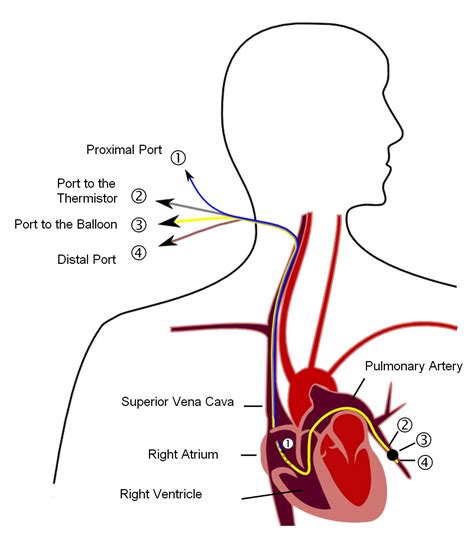 File:Pulmonary artery catheter english.JPG - Wikimedia Commons