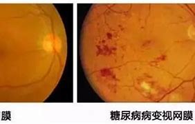 Image result for 视网膜病变