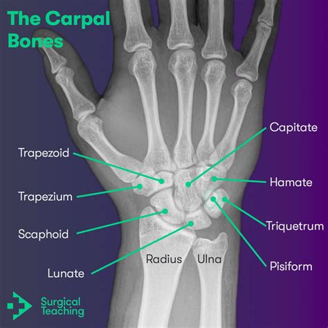 Carpal Bones Xray EPOS™ C 1548