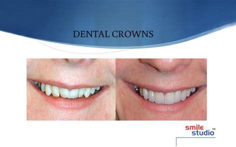 Dental Bridges and Crowns