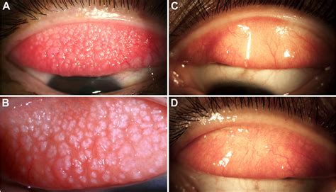 Papillary Conjunctivitis Allergic Eye Diseases