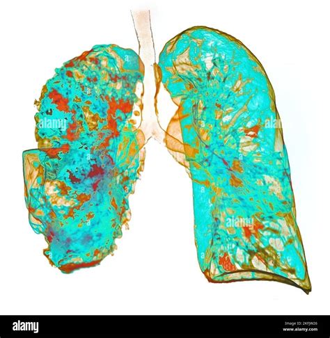 Pneumonia, 3D CT scan Stock Photo - Alamy