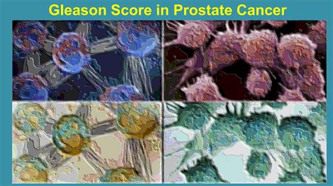Prostate Cancer and Gleason Score | PPTX
