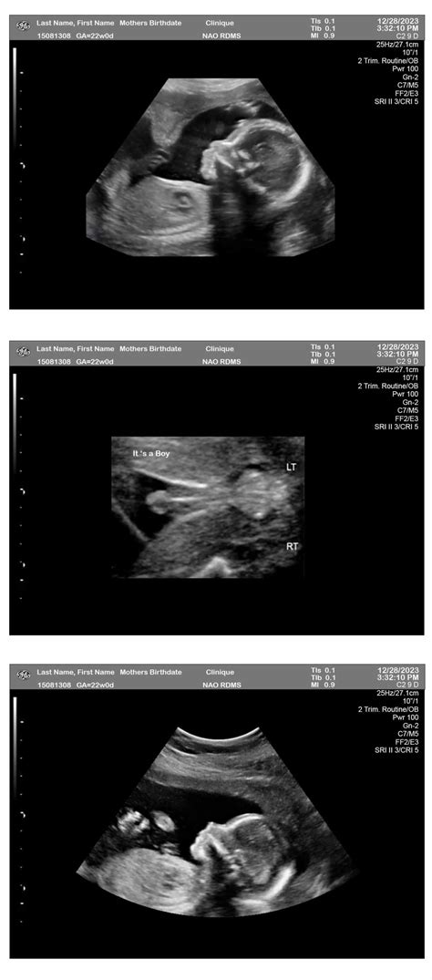 Baby Boy Ultrasound 14 Weeks at Anthony Pippen blog