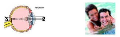 Refractive errors-Sri Venkateshwara nethralaya- Eye-hospital ...