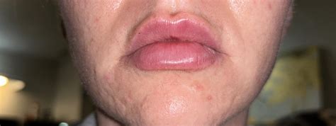 Lip Filler Migration : r/cosmeticsurgery