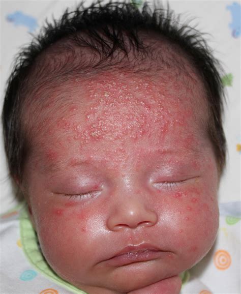 Neonatal Cephalic Pustulosis