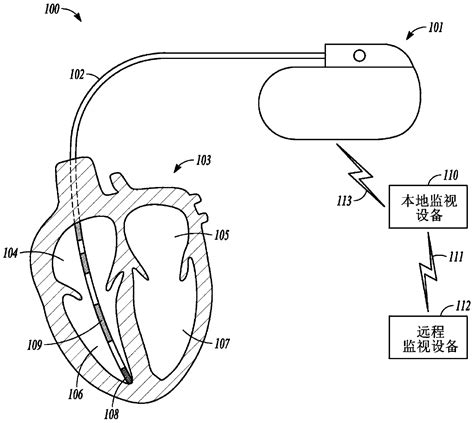 Atrial Fibrillation Detection Using Ventricular Rate Variability - Eureka | Patsnap