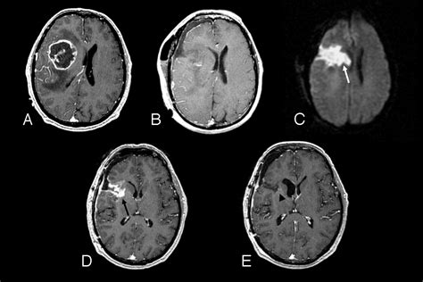 Update on Brain Tumor Imaging: From Anatomy to Physiology | American Journal of Neuroradiology