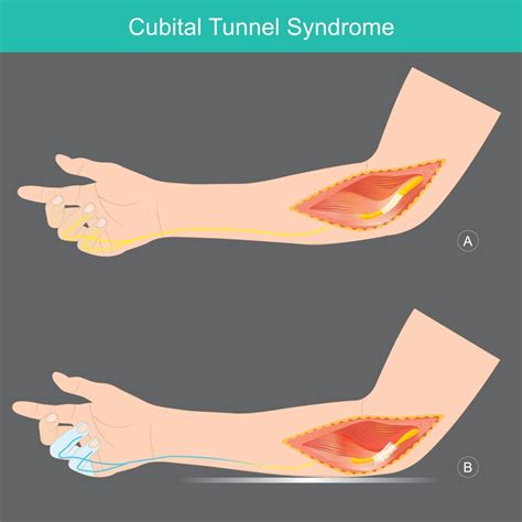 Cubital Tunnel Release: Treatment and Recovery - JOI Jacksonville ...