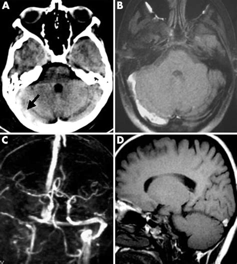Headache as the only neurological sign of cerebral venous thrombosis: a series of 17 cases ...