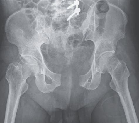 Open-Book Pelvic Fracture - MEDizzy