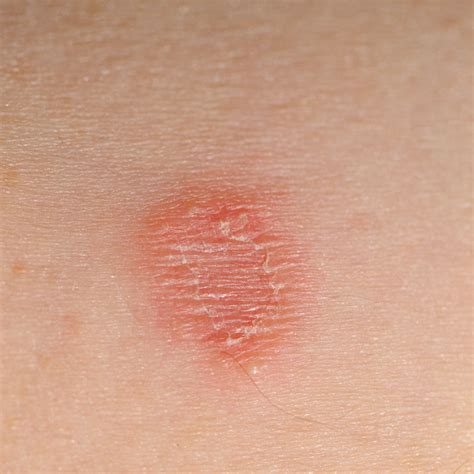 Circular Rashes That Aren't Ringworm, According to Doctors