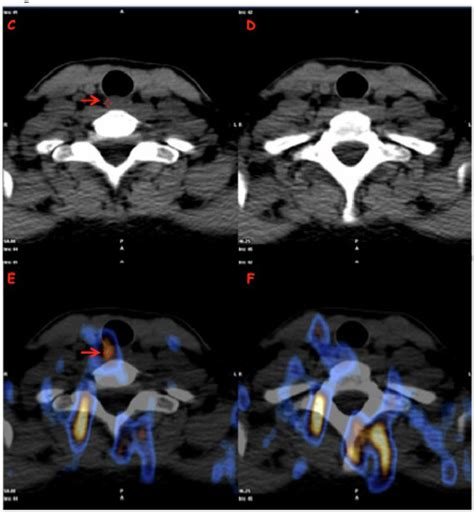 Thyroglobulin Value Predict Iodine-123 Imaging Result in Differentiated ...