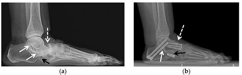 Imaging and Treatment of Posttraumatic Ankle and Hindfoot Osteoarthritis