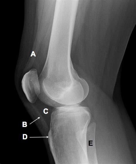 Lateral Knee X Rays