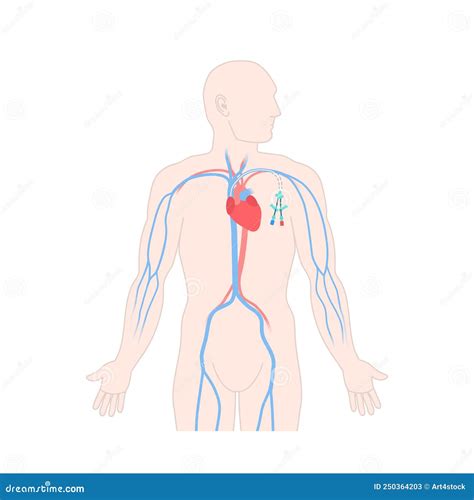 Tunneled Central Line Venous Catheter on Male Body Stock Vector ...