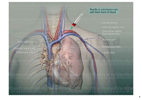 CASE AT A GLANCE: Chemo Port Placement Venous Access — Illustrated Verdict