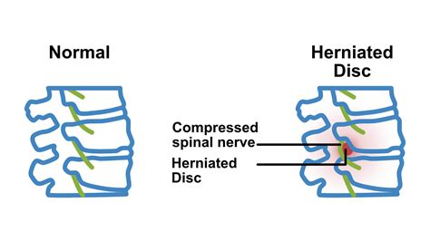 Herniated Disk | Chiropractors in Huber Heights, Dayton, OH
