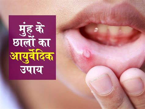 इन 3 पोषक तत्वों की कमी से होता है माउथ अल्सर, मुंह के छालों की तकलीफ ...