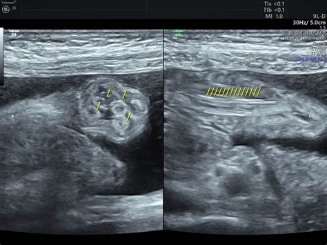 Cluster of worms in intestine. Abdomen ultrasound,