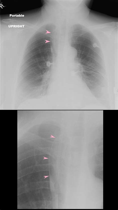 Structure Normal Lungs Azygos fissure | The Common Vein