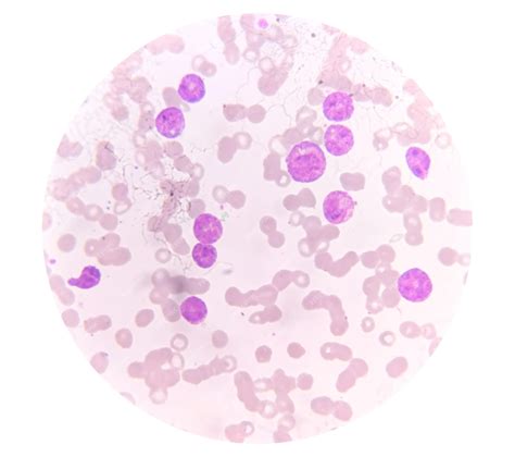 La leucemia mieloide aguda (lma) es un tipo de cáncer de la sangre ...