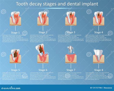 Tooth Decay Stages and Dental Implant Vector Illustration Stock Vector - Illustration of molar ...