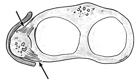 Proximal Tibiofibular Joint: An Often-Forgotten Cause of Lateral Knee Pain | AJR