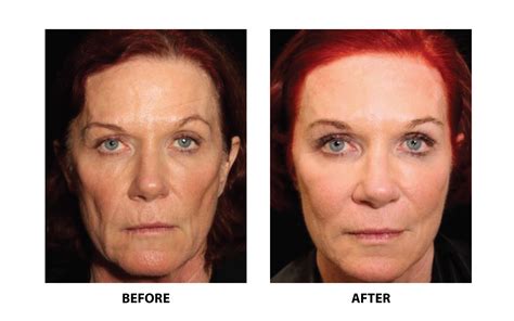 Boston Thread Lift Non Surgical Face Lift Before & After - Dr. Numa
