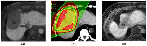 Proton Beam Therapy without Fiducial Markers Using Four-Dimensional CT ...