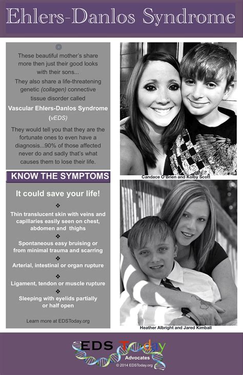 Vascular Ehlers-Danlos (vEDS) check out the entire diagnostic criteria. | Elhers danlos syndrome ...