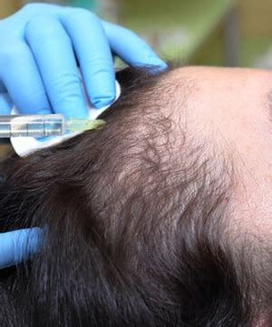 Expert Biotin PRO PRP Hair Restoration Treatment in Karur