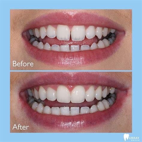 Composite Bonding Northern Ireland | Murray Dental Omagh