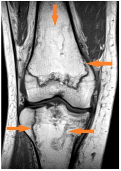 Avascular Necrosis Bone Complication after Active COVID-19 Infection ...