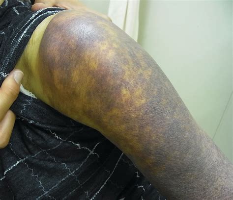 Extensive Ecchymosis due to Rotator Cuff Tear | The Journal of Rheumatology