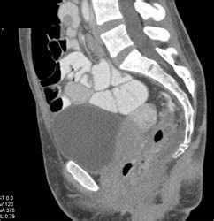Bildergebnis für ruptured abscess on colon
