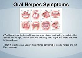 Herpes   oral sex