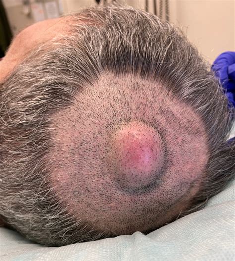 Pathology Outlines - Trichilemmal (pilar) type