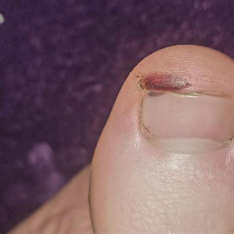Yesterderday I noticed this dark mark on my big toe and I don't know how I got it, I didn't stub ...
