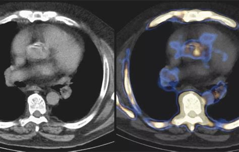 Thoracic aortic 18F-sodium fluoride PET predicts future ischemic stroke ...