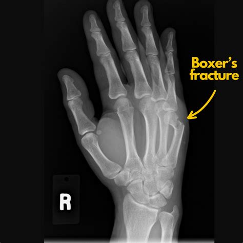 What Is A Boxer’s Fracture? Does My Broken Hand Need Surgery — Dr. Nick ...
