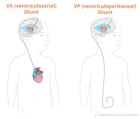 Shunt Hydrocephalus Ventriculoperitoneal Shunt For Hydrocephalus
