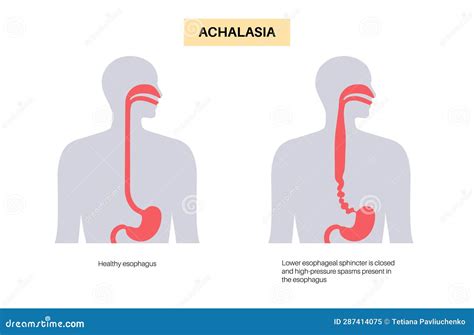 Esophageal Achalasia Wikipedia