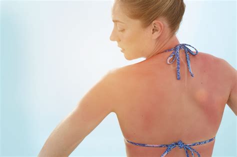 Why Does Sunburn Itch, Severe, Unbearable & Treatment of Itchy Sunburn - American Celiac