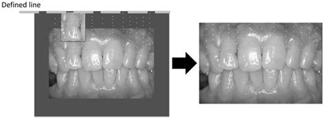 Gingival Pigmentation Affected by Smoking among Different Age Groups: A ...