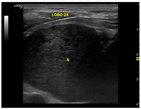 Thyroid-Bed Schwannoma Mimicking a Thyroid Neoplasm: A Challenging ...